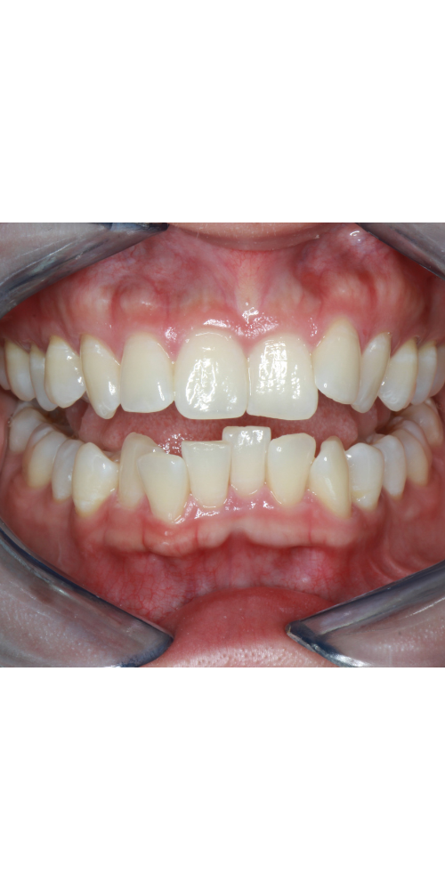 Invisalign Alignment - Before