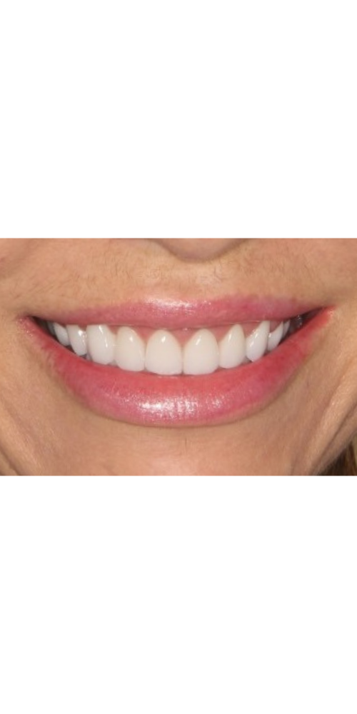 Full-Mouth Revitalization - After