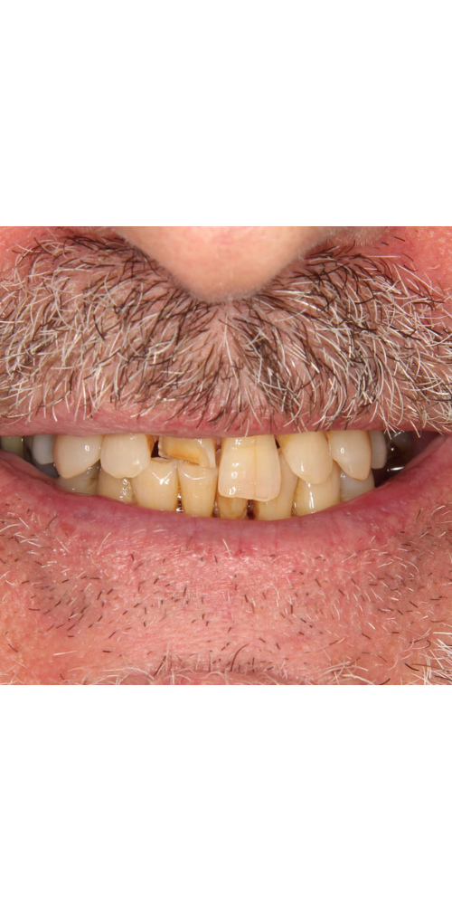 Zirconia Crown Transformation - Before