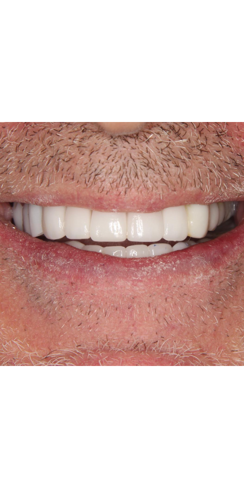 Zirconia Crown Transformation - After