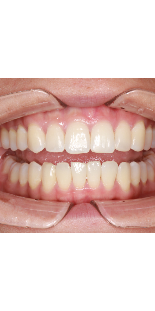 Invisalign Alignment - After