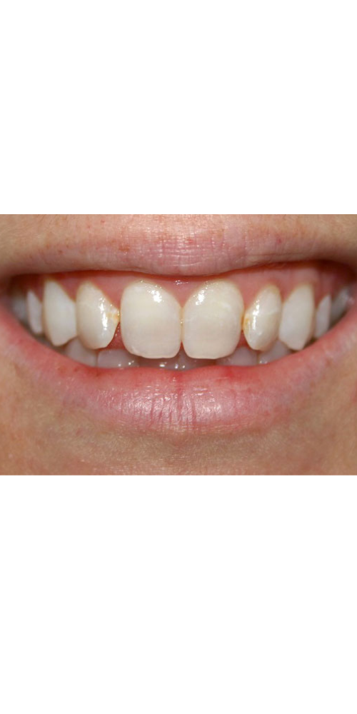 Veneer Aesthetic Enhancement - Before
