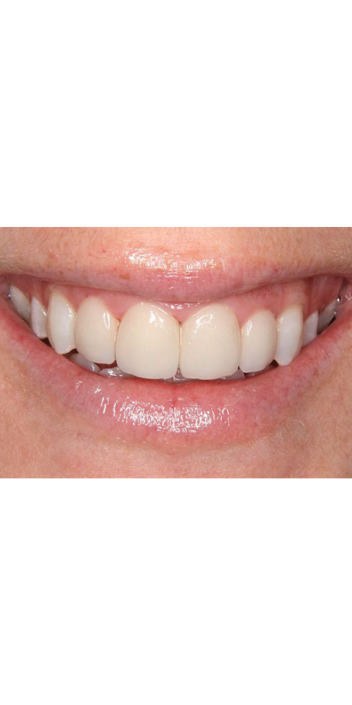 Veneer Aesthetic Enhancement - After
