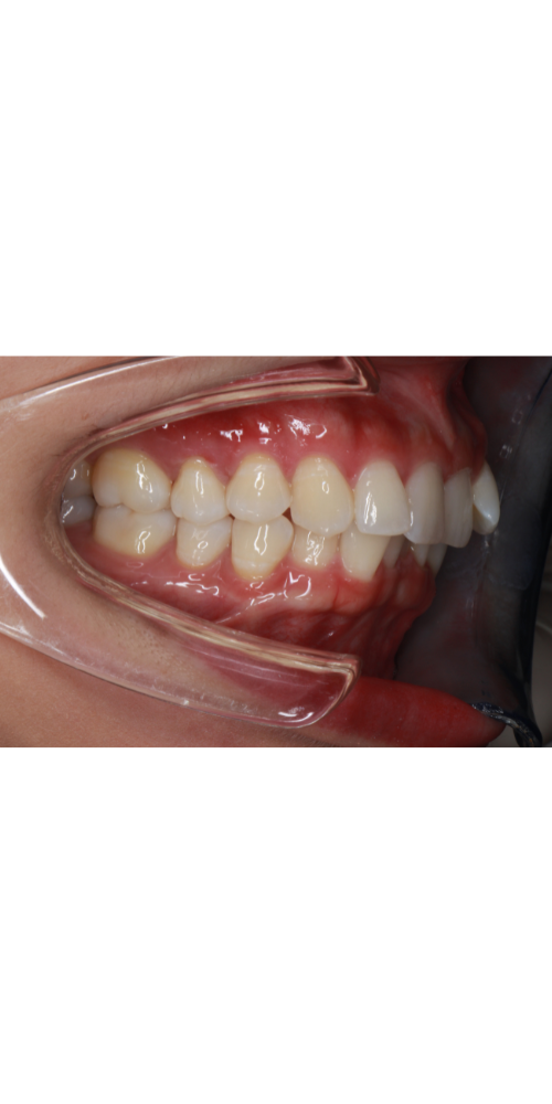 Invisalign Alignment - Before