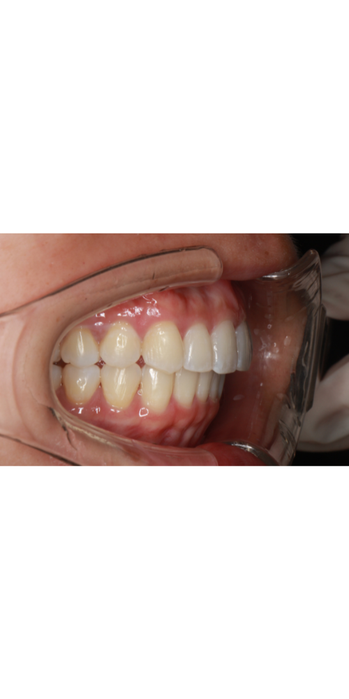 Invisalign Alignment - After