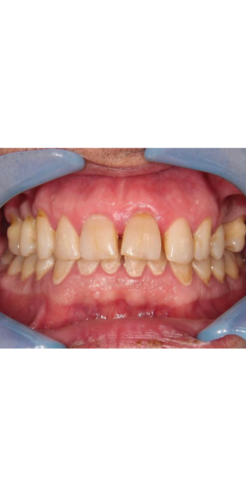 Stage Smile Makeover - Before