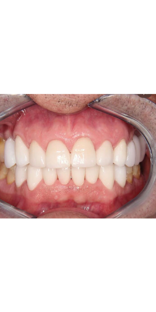 Stage Smile Makeover - After