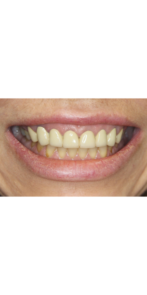 Full-Mouth Revitalization - Before