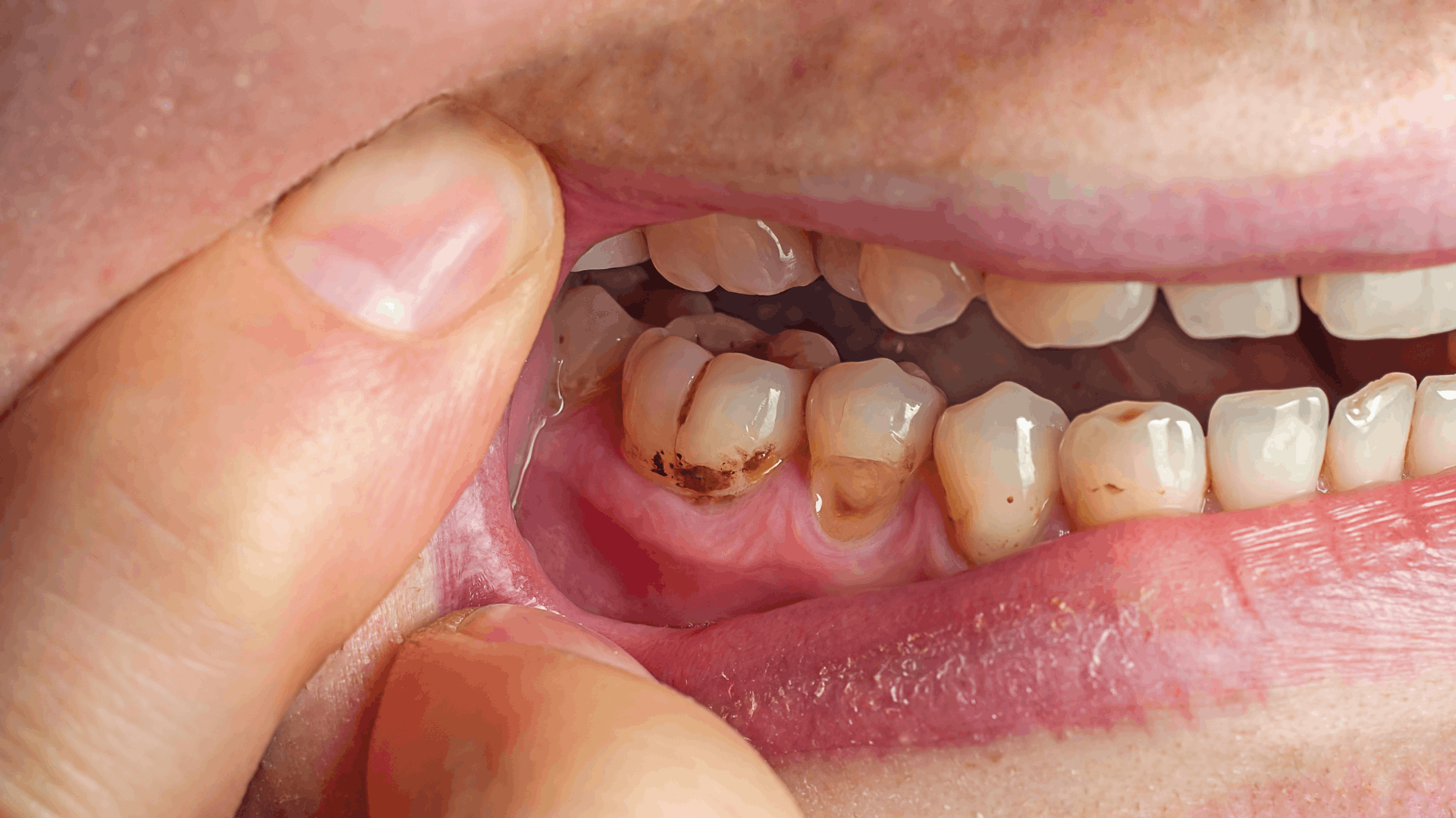 Why Plaque and Tartar Are Dangerous: What You Need to Know About Your Oral Health